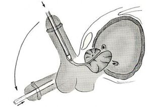 Schéma de chirurgie endoscopique d’agrandissement du pénis. 